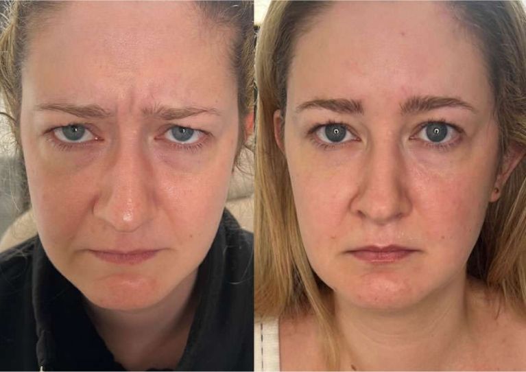 Before and after facial expression comparison.